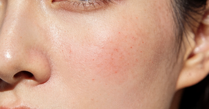 Renforcer la barrière cutanée Strengthen Skin Barrier